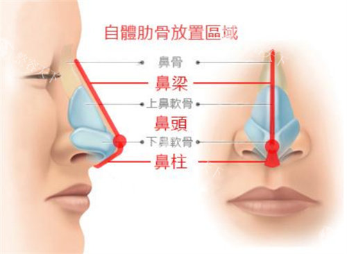 鼻部整形示意图