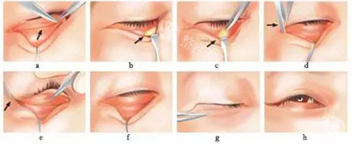 去眼袋手术方法