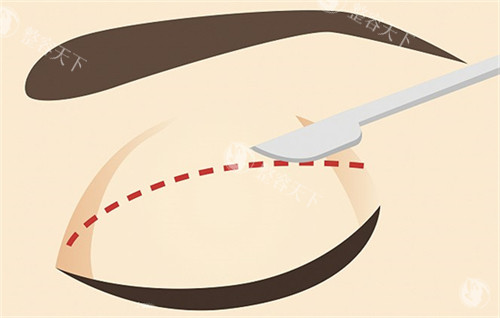 双眼皮的切口切线