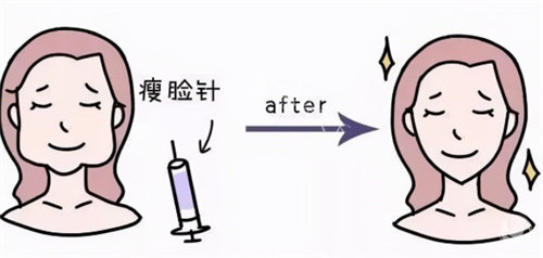 瘦脸注射前后卡通 瘦脸注射前后卡通