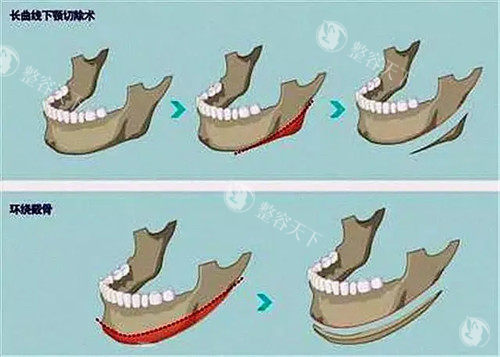 不同下颌骨结构方式对比图 不同下颌骨结构方式对比图