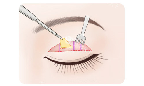 全切双眼皮脂肪切除