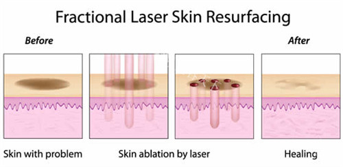 激光祛斑流程图