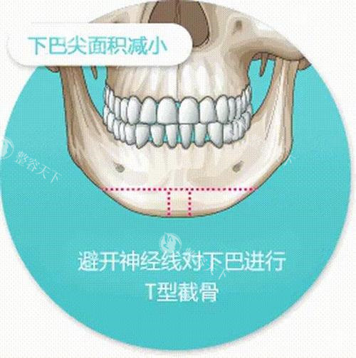 T型截骨术手术切口线演示图 T型截骨术手术切口线演示图