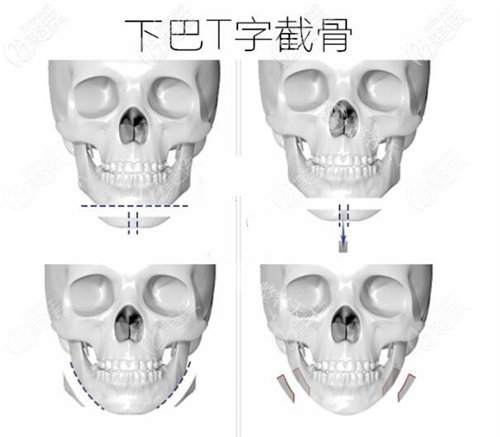 T型截骨术手术步骤动画图 T型截骨术手术步骤动画图