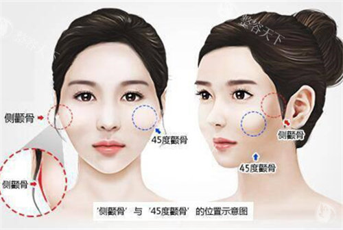 分享国内做一针降颧骨好的医院:北京艺美/广州韩后/广州曙光做一针降颧骨都很擅长!