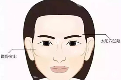 面部轮廓问题示意图 面部轮廓问题示意图