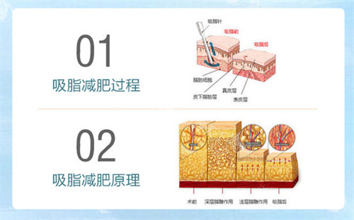 广州王世虎吸脂和脂肪填充怎么样？个人简介/技术特色/在哪上班信息分享！附联系方式