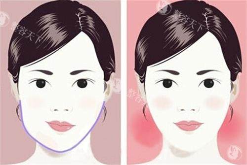 面部不对称和正常面部的区别 面部不对称和正常面部的区别