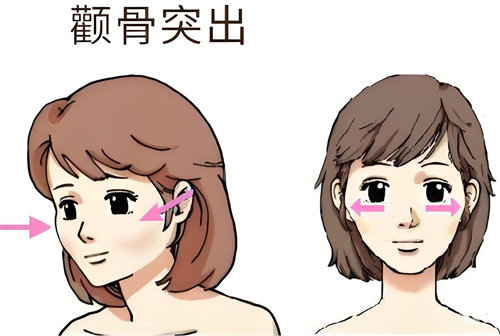 分享国内做一针降颧骨好的医院:北京艺美/广州韩后/广州曙光做一针降颧骨都很擅长!