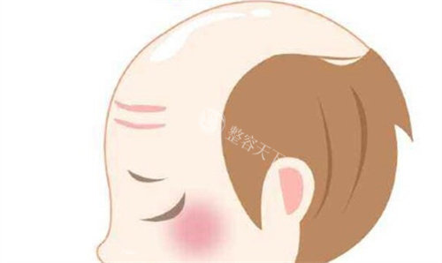 秃头 秃头