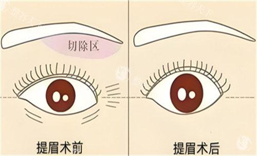 提眉手术前后对比