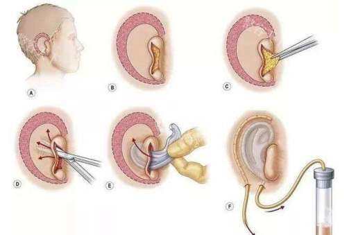 耳再造手术演示动画图