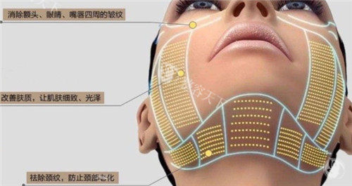 热玛吉皮肤作用细节图