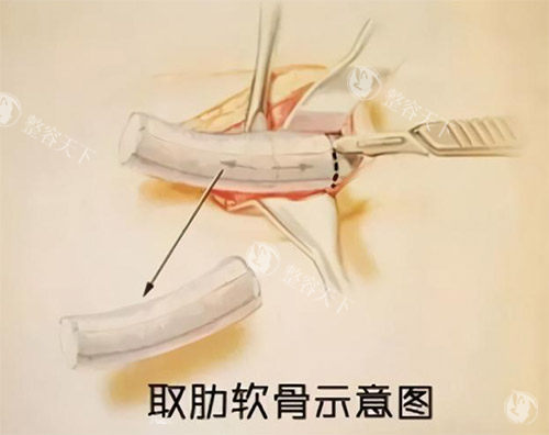 肋骨鼻手术过程图 肋骨鼻手术过程图