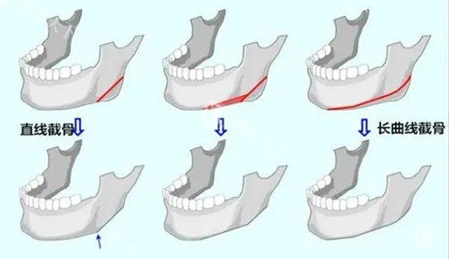 下颌骨截骨整形卡通示意图