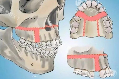正颌手术示意图