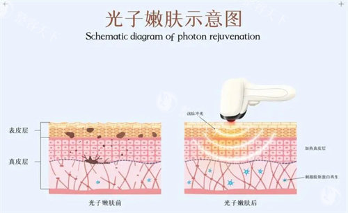 白瓷娃娃和光子嫩肤的区别是什么？二者可以一起做吗？深度解析二者区别！