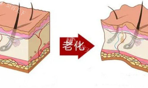 双燕尾提拉是什么？也是线提升吗？双燕尾smas提拉价格-手术原理-维持时间-风险副作用分析