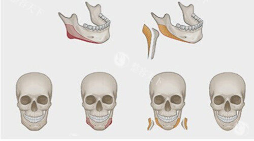 下颌骨外板整形卡通示意图