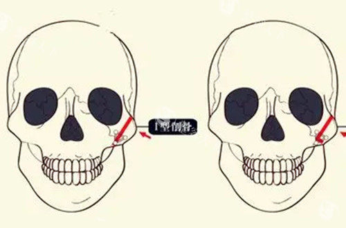 颧骨磨骨整形卡通示意图