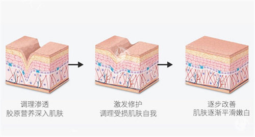 III型胶原蛋白填充原理