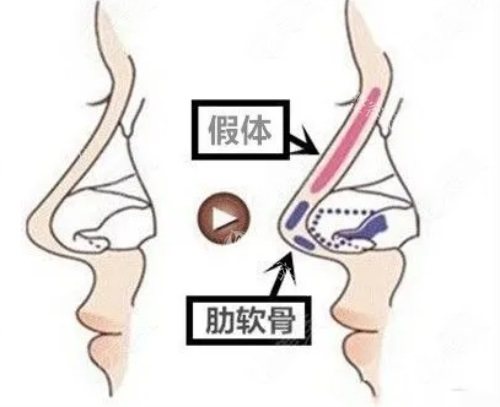 宫风勇和夏正义做鼻子谁好，两位医生在鼻整形领域各有千秋口碑都很不错！