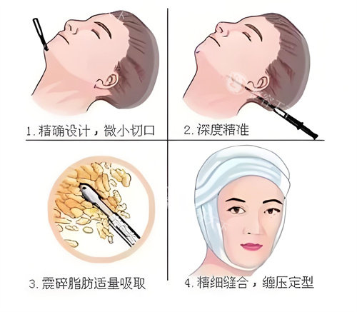 面部吸脂手术过程演示动画图 面部吸脂手术过程演示动画图