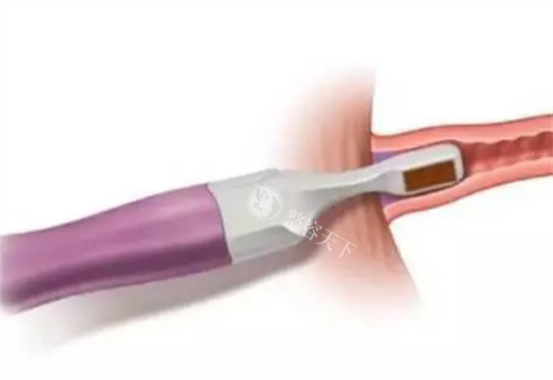 viveve薇蜜私密紧致仪器治疗过程图解 viveve薇蜜私密紧致仪器治疗过程图解
