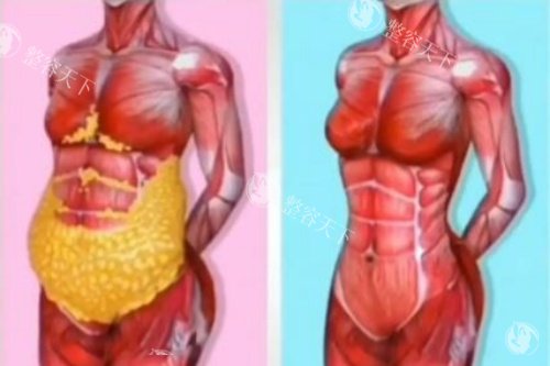 马梅生做腰腹环吸怎么样？我63天已经掉了8cm没有凹凸不平