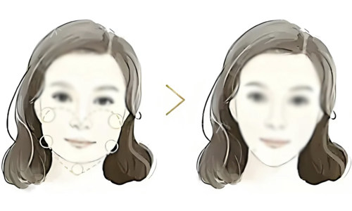 真相揭秘：面部吸脂后，皮肤会松弛吗？深析面部吸脂后皮肤松弛的原因真相~