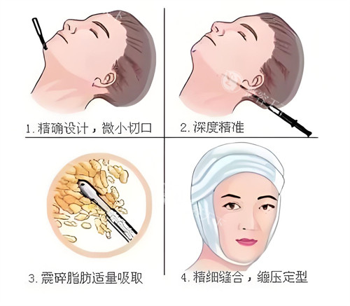 【科普贴】面部吸脂大概多少钱？面部整体吸脂约8000元起|双下巴吸脂约5000元起~并解析面吸费用构成！