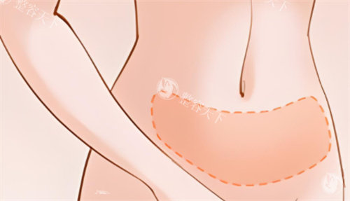 吸脂腹部区域 吸脂腹部区域