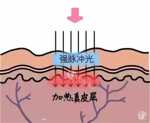 光子嫩肤多久做一次好？治疗间隔通常建议为3-4周一次！