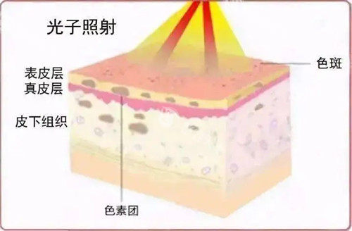 BBL光子嫩肤和M22区别是什么？从技术原理、治疗范围、操作复杂度和价格等帮您区分下！