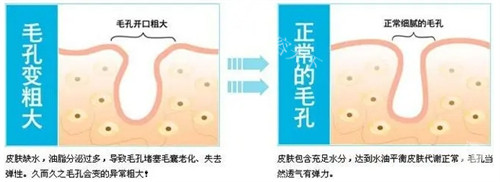 M22光子嫩肤的功效和作用介绍！可以祛斑、祛红血丝、嫩肤与紧致、缩小毛孔等！