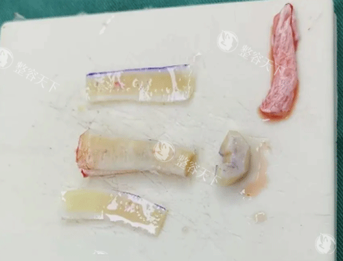 肋骨鼻亲身经历分享：术后改善过程太痛苦了！但鼻型变化真的大！我终于拥有高鼻梁了