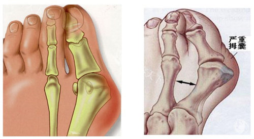 求推荐!乌鲁木齐做大脚骨手术哪家强?王共礼|青松星范容拇外翻矫正手术不错