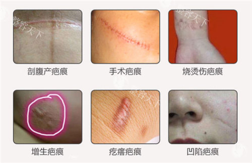 苏州乐桥疤痕医院做疤痕修复好吗?好 简单和复杂的疤痕他们家都能处理的比较好！