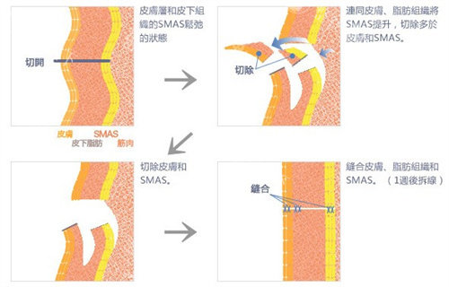 AZO上悬术价格多少钱？2-5万元+，可维持1年左右/改善原理/成效展现揭秘！