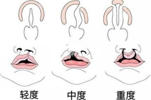 唇腭裂怎么申请免费治疗?2025腭裂免费申请指南公布!微笑列车唇腭裂免费申请流程揭晓!