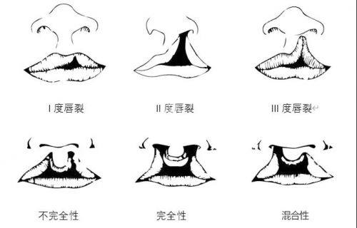 唇腭裂怎么申请免费治疗?2025腭裂免费申请指南公布!微笑列车唇腭裂免费申请流程揭晓!