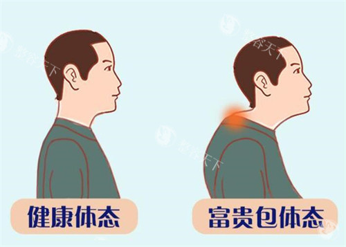 【富贵包治疗24小时在线询问】治疗富贵包好的医院医生在线查询,预约富贵包医院医生很方便!