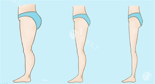 小腿吸脂用什么方法好？负压吸脂、超声吸脂、水动力吸脂等都不错！