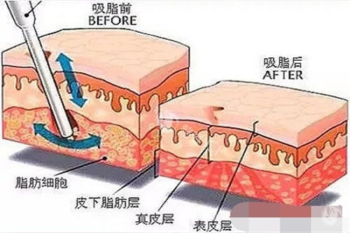 成都王欣吸脂怎么样？技术娴熟|服务好|价格合理！