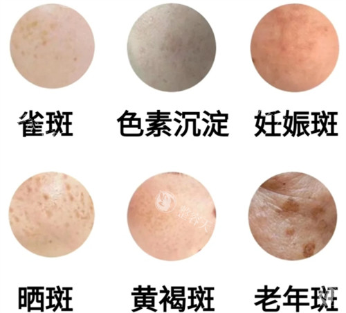 南昌祛斑去哪家比较好？南昌祛斑中山皮肤病医院和莱美美容医院祛斑比较靠谱！