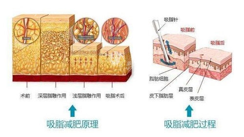 成都李烈医生吸脂怎么样，技术成熟有多年的吸脂手术经验！