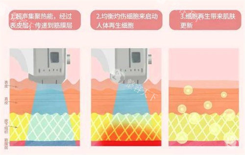 2025北京超声美容收费项目一览表：全脸1.88w+单部位6800+超声炮联合治疗4.58w+