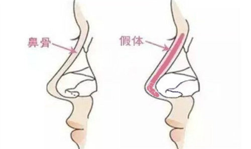 肋骨鼻和超肋的区别在哪？从材质特性、手术过程、术后结果、适用人群、价格等方面对比下！