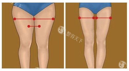 直腿塑形和腿部吸脂一样吗？不一样！从原理、适应症、优缺点等对比下